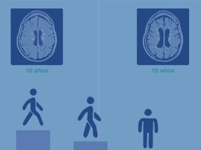 Atrofia Cerebral